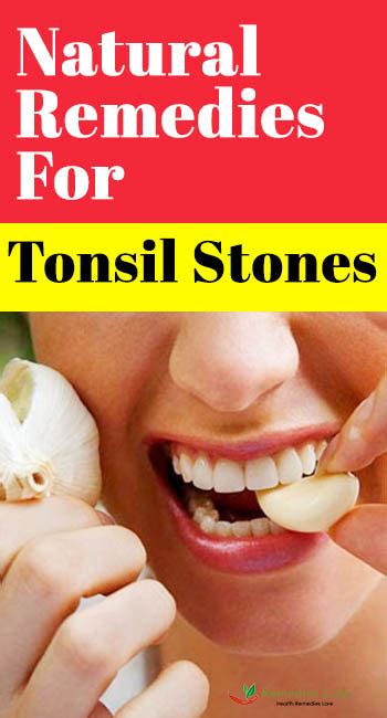 Natural Remedies For Tonsil Stones Remedies Lore