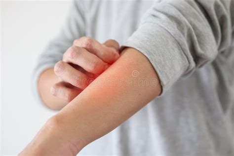 Man Itching And Scratching On Arm From Itchy Dry Skin Eczema Dermatitis