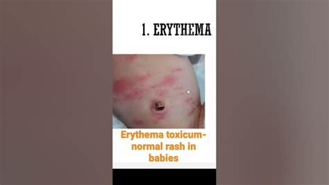 What Is This Red Rash On My Newborn Baby Erythema Toxicum Normal Rash