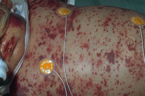 Saffron kashmir supermongra kualitas terbaik #saffronkashmir #jualsaffronkashmir #saffronkashmirmongra Uitbreiding vaccinatie meningokokken met extra cohorten ...