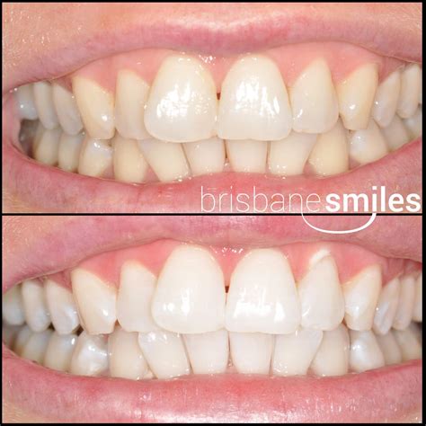 Teeth Whitening Photos Brisbane Smiles