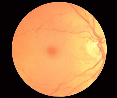 Alternative treatment of red spots on the palms can be applied rather in a complex of medical measures, it does not exclude a visit to a doctor, diagnostics. CRAO with Cherry Red Spot - Retina Image Bank