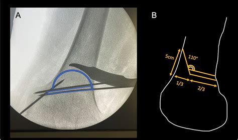 Closing Wedge Distal Femoral Osteotomy For Knee Valgus Indications