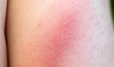 Coronavirus Symptoms Whats That On Your Skin Could A Red Rash Be A