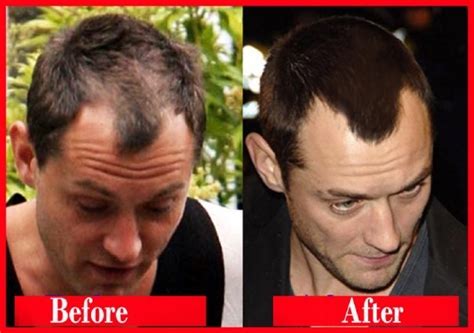 jude law before and after his hair transplant