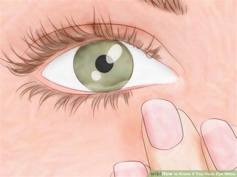 How To Know If You Have Eye Mites Symptoms And Treatments Eye Mites
