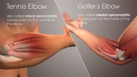 12 photos of the forearm tendon anatomy picture. Tendonitis | Bondi Gym