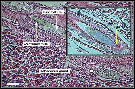 You will notice that all normal moles pictures are quite different from one another, making it harder to detect skin cancer only by a few pictures. Mites
