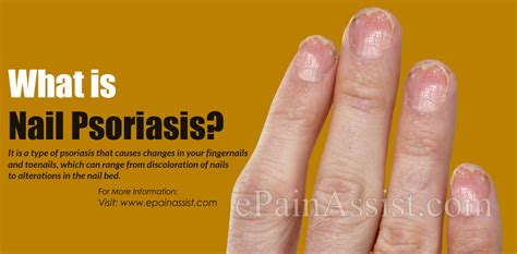 Nail Psoriasis Symptoms Treatments And Home Remedies