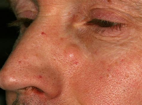 How To Spot And Treat Epidermoid Cysts