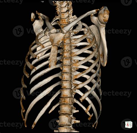 X Ray And Ct Scan Thoracic Spine 26433990 Stock Photo At Vecteezy