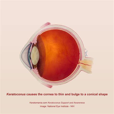 Keratoconus Eye Diagram Keratoconus Causes The Cornea To T Flickr