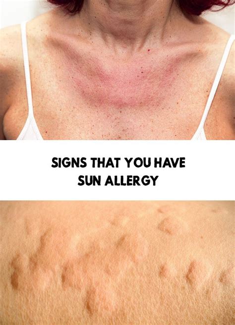 Sun Allergy Signs That You Have Sun Allergy Sun Allergy Allergies