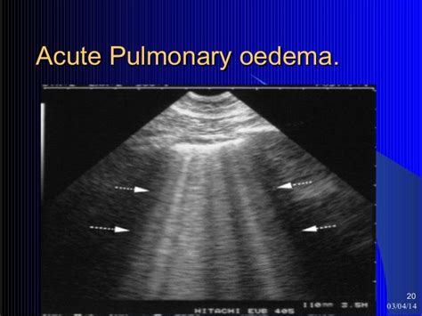 Lung Ultrasound Pulmonary Edema