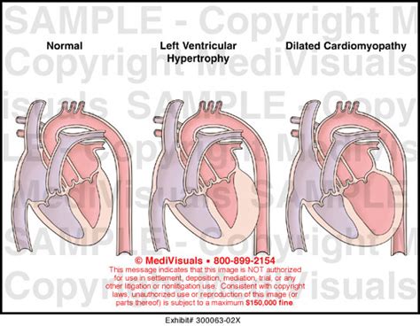 Dilated Cardiomyopathy Medical Illustration Medivisuals