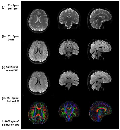 Whole Brain Diffusion Tensor Imaging Using Single Shot Spiral Sampling
