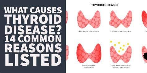 What Causes Thyroid Disease 14 Common Reasons Listed