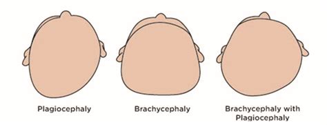 Plagiocephaly Or Flat Head Syndrome In Babies All You Need To Know