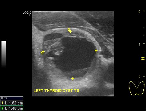 Thyroid Cysts Dr Jeeve Ent Specialist