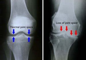 It occurs in more than 8000 dogs each year in the usa. Knee pain, runner's bane: beware the canyons of your mind!