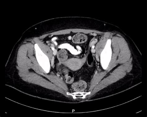 Ct Scan Of The Abdomen Showing Enlarged Retroperitone