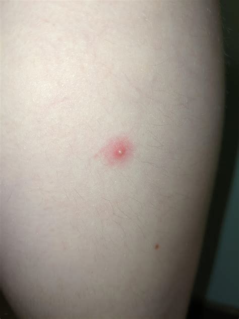 Pimple-like thing on thigh of 4yo. Anything to worry about? : r/DiagnoseMe