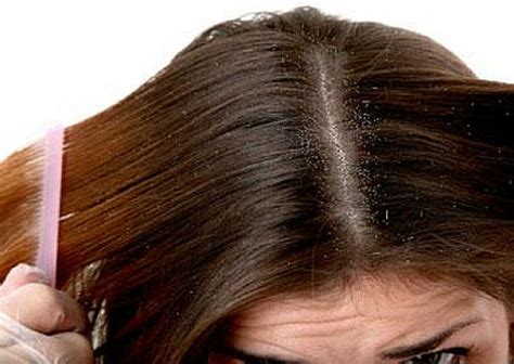 How To Get Rid Of Dandruff Lifestylica