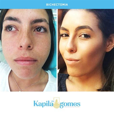 La extracción de la bolsas de bichat llamada también bichectomia es una intervención quirúrgica que se aplica a la estética facial, consiguiendo mejorar el contorno de las. TUDO SOBRE BICHECTOMIA - COM DRA KAPILA GOMES - Flávia Carboni