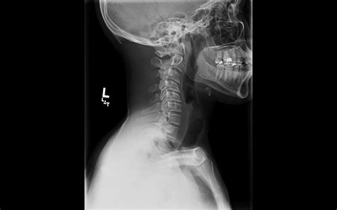Anterior Cervical Discectomy And Fusion Sohrab Gollogly Md