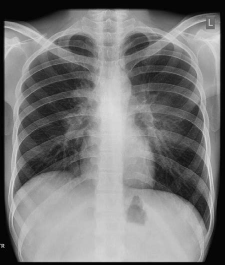 Figure 1 present some samples of normal and pneumonia lung. Chest X ray PA view showing normal lung fields and ...