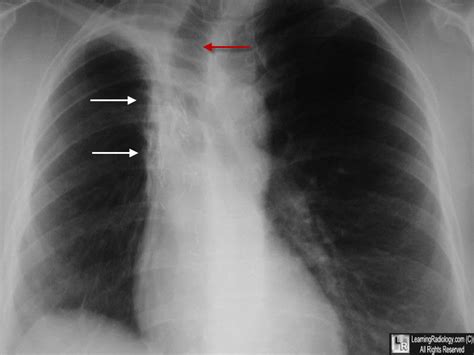 Learningradiology Radiation Fibrosis Pneumonitis