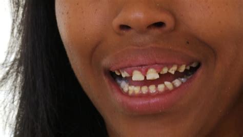 Adult With Baby Teeth Causes And Treatments My Best Dentists Journal