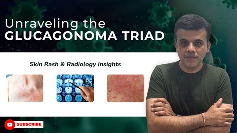 Unraveling The Glucagonoma Triad Skin Rash And Radiology Insights Dr