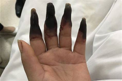 una donna si è ferita alle mani che sono diventate nere foto