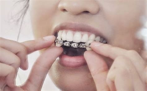 Bahana Pendakap Gigi Palsu Harian Metro