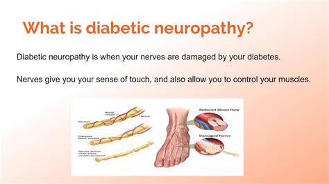 Diabetic Neuropathy An Introduction Youtube