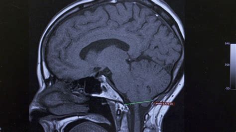Chiari Malformation Screenshot Mhsi Michigan Head Spine Institute Blog