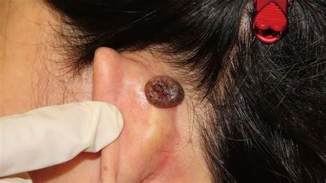 What Causes Lumps Behind The Ears