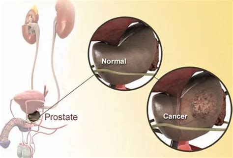 Early Signs Of Prostate Cancer Stages Survival Rate Treatment Causes