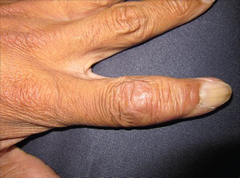 Subcutaneous Nodules On The FingersQuiz Case Dermatology JAMA