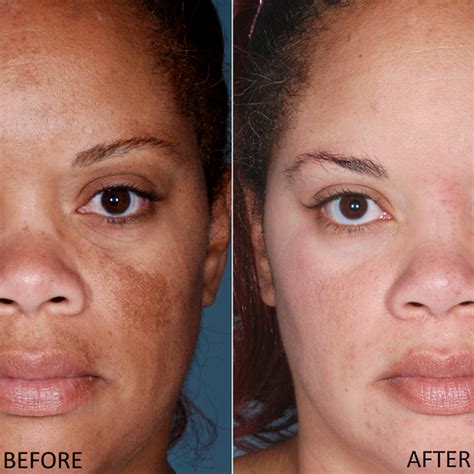 How To Treat Hyperpigmentation With Hydrocortisone Justinboey