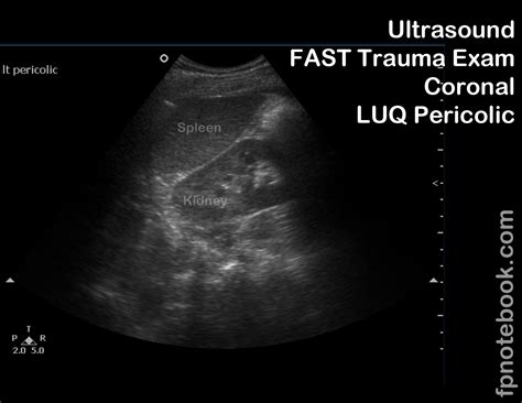 left-intercostal-oblique-ultrasound-view