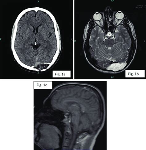 A Ct Fi Ndings Highly Suggestive Of An Intradiploic Dermoid Cyst