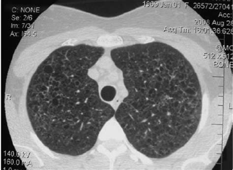 High Resolution Computed Tomography Hrct Of The Lungs Of A Patient