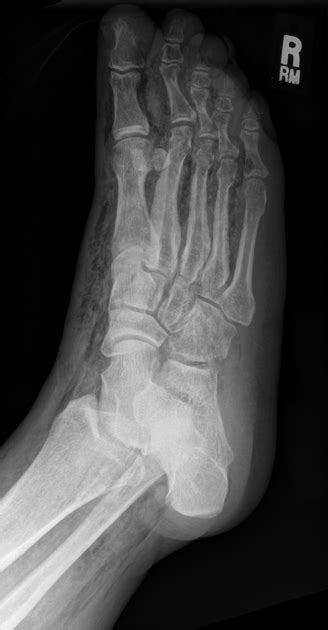 Necrotising Faciitis In A Diabetic Foot There Is Extensive