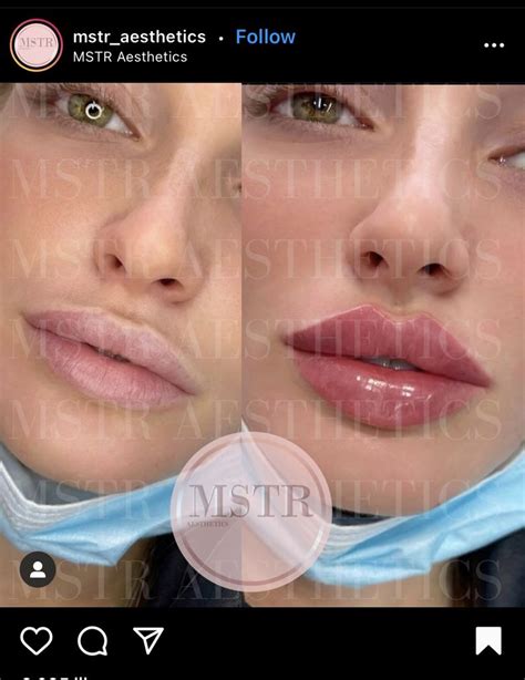 Pin By Tako Davitashvili On Lips In 2021 Lip Fillers Lip Injections