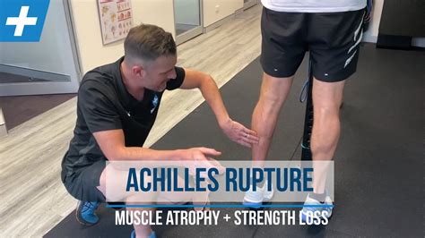 Achilles Rupture Rehab Calf Muscle Atrophy And Strength Loss Tim