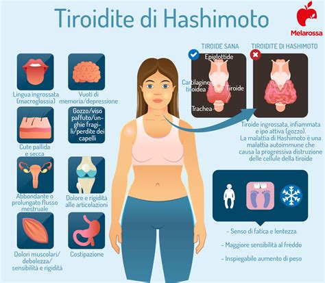 Tiroidite Di Hashimoto Che Cos Sintomi Diagnosi E Cure