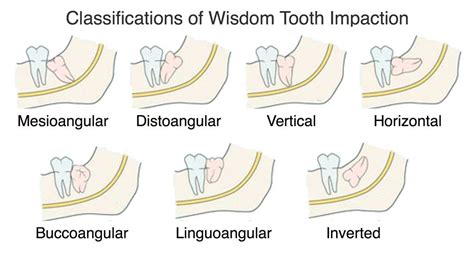 Wisdom Tooth Impaction In Ventura Ca Pacific Oral Surgery