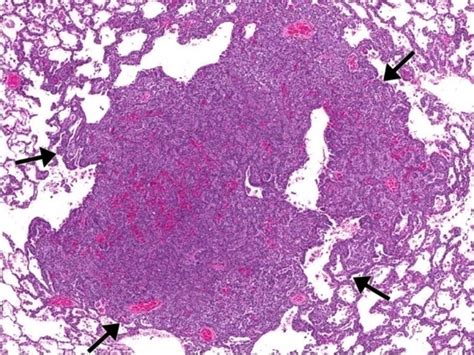 Figure 7 Alveolarbronchiolar Adenoma In The Lung Ntp